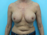 Breast Implant Exchange