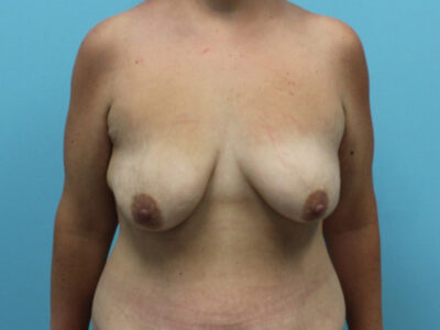 Augmentation & Mastopexy