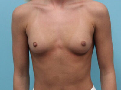 Breast Augmentation