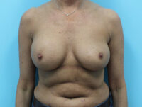 Breast Implant Exchange