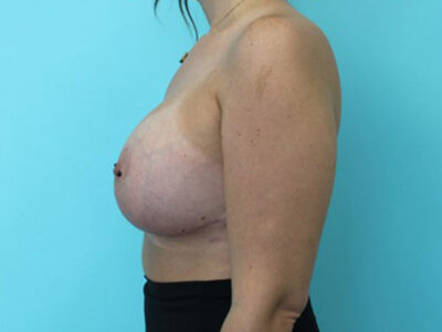 Augmentation & Mastopexy