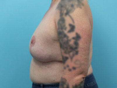 Augmentation & Mastopexy