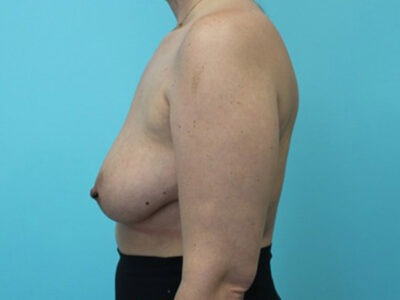 Augmentation & Mastopexy