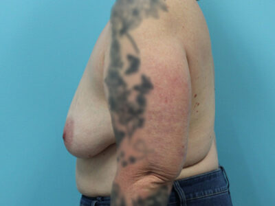 Augmentation & Mastopexy