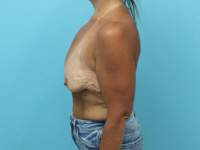 Augmentation & Mastopexy