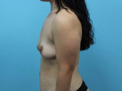 Breast Augmentation