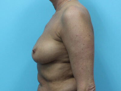 Breast Implant Exchange